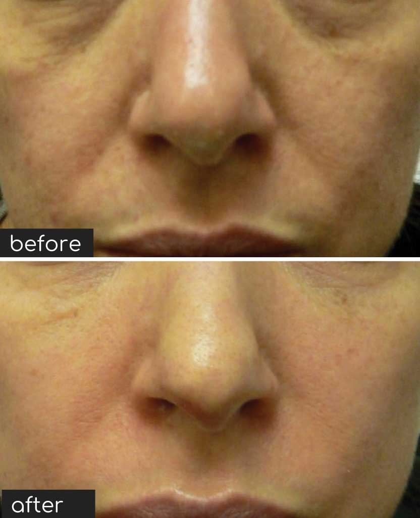 nasolabial fillers before after studiomd
